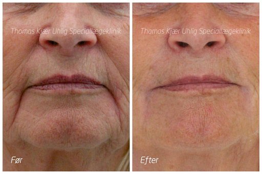 Kvinde før og 4 år efter Restylane behandling af mundvige.