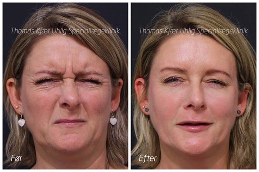 Kvinde før og efter Botox i bekymringsrynken. Kniber øjnene sammen.