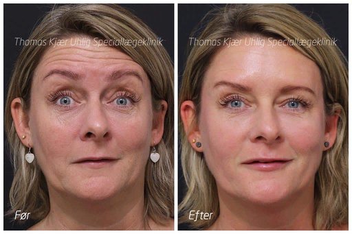 Botox behandling af panderynker. Kvinde før- og efterbillede aktiv pande.