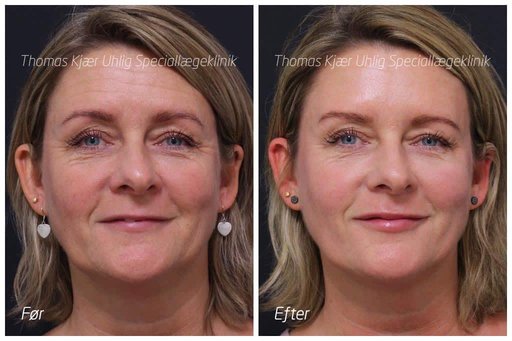 Botox behandling af panderynker. Kvinde før- og efterbillede afslappet pande.