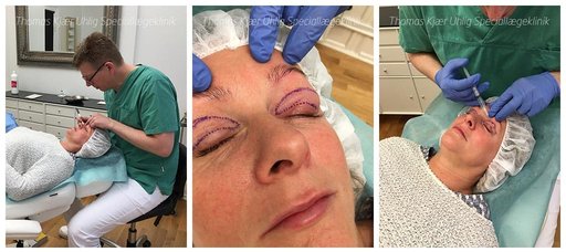 Kvinde forberedes til operation af øvre øjenlåg. Der designes det snit der skal laves og vises det ene øjenlåg umiddelbart efter endt kirurgi.
