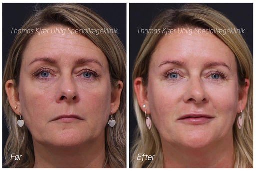 Kvinde før og efter øjenlågsoperation og behandling med Botox og Restylane. Bemærk helhedsindtrykket som er mere friskt og feminint.
