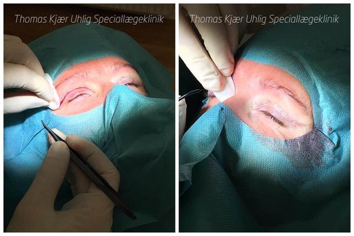 Kvinde under en øjenlågsoperation af øvre låg. Det venstre øje er færdigopereret og det højre næsten syet færdigt. Patienten ses umiddelbart efter operationen.