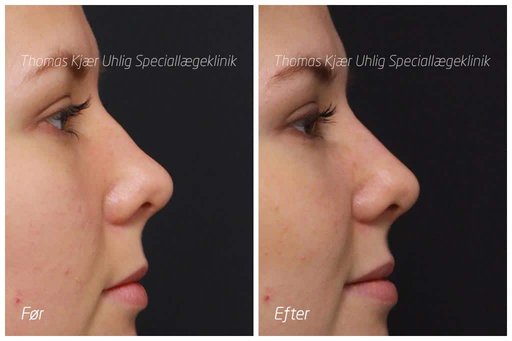 Før og efterbillede af kvinde som har fået foretaget næsekorrektion med filler.