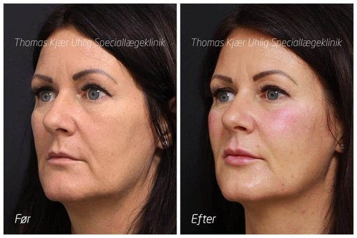 Kvinde før og efter Restylane behandling til kinben og læber