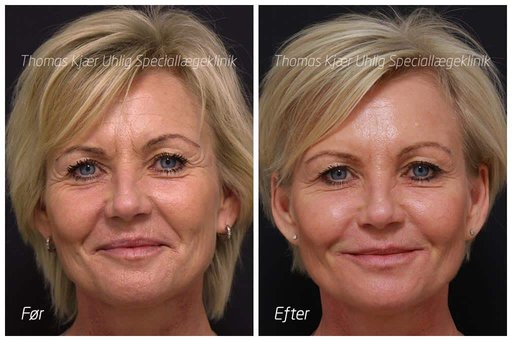 Kvinde før og efter Botox i bekymringsrynken