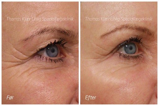 Kvinde før og efter Botox behandling mod smilerynker ved øjnene. Rynkerne er mindsket væsentligt.