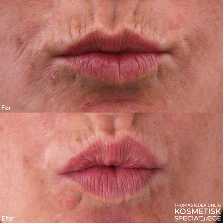 Før og efterbillede af kvindemund som kysser før og efter en Botox behandling. Det ses hvordan det muskulære træk er mindsket på efterbilledet. Kombineret med en diskret læbeforstørrelse får man et fint og naturligt resultat.