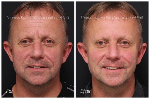 Journalist Claus Elgaard før og efter Botoxbehandling omkring øjnene